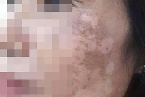 Da mặt loang lổ vì dùng lá trầu không trị nám