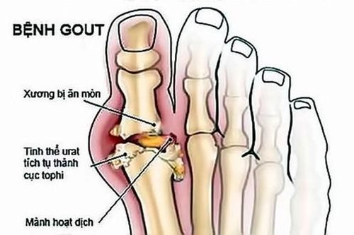 Nguy cơ lạm dụng Corticoid điều trị bệnh xương khớp
