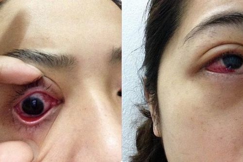 Nối mi giả, cô gái trẻ bị tụ máu, nhiễm trùng mắt