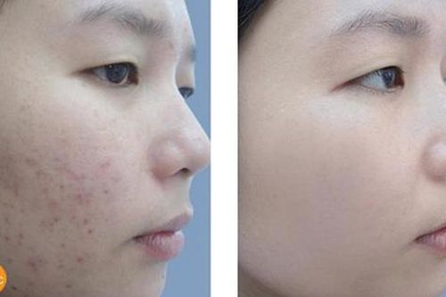 Dùng vitamin C chuẩn cách này, làn da trắng đẹp, sạch mụn cực nhanh