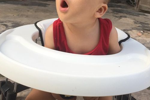 Đau thương số phận của bé trai 11 tháng tuổi sinh ra bị dính mí mắt bẩm sinh