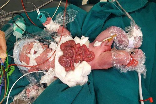 Tội nghiệp 2 bé sơ sinh vừa chào đời lộ nội tạng ngoài thành bụng