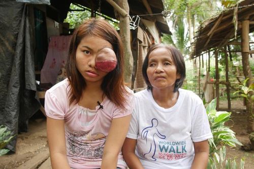 Nuôi tóc dài che nửa khuôn mặt, cô gái đáng thương dấu diếm khối u sưng phồng một bên mắt