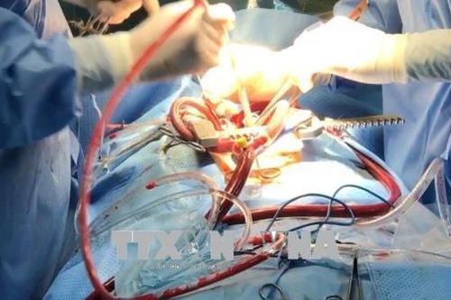 Chuyển giao kỹ thuật phẫu thuật tim cho Bệnh viện đa khoa Trung ương Cần Thơ