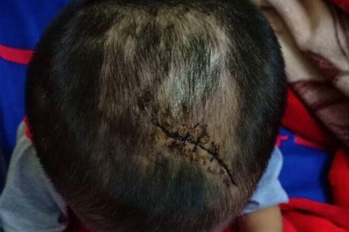 Nghi bé trai 3 tuổi bị mẹ ruột cùng cha dượng đánh đập đến thương tích