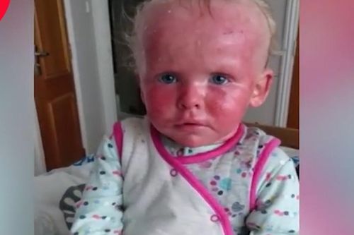 Bé gái 2 tuổi có làn da đỏ như 'tôm luộc' vì bệnh vảy nến