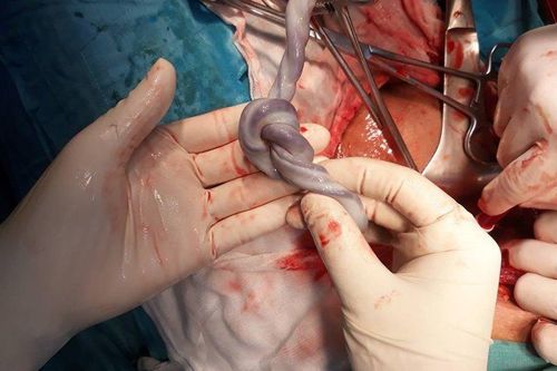 Một giờ căng thẳng mổ cứu thai nhi có dây rốn thắt nút trong bụng mẹ