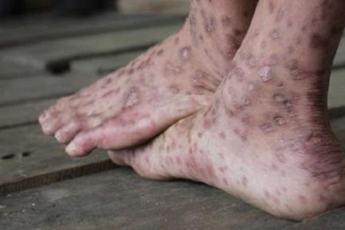 Người đàn ông bán dép ở chợ đêm bị ghẻ ngứa 'hành hạ'