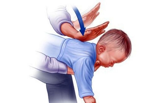 Hóc dị vật: Trẻ có thể phải sống thực vật
