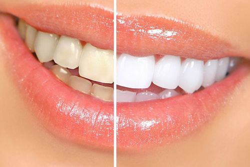 Nụ cười tỏa sáng chỉ nhờ 5 cách làm trắng răng đơn giản tại nhà