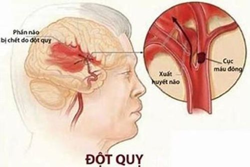 Mối liên hệ tăng huyết áp và đột quỵ