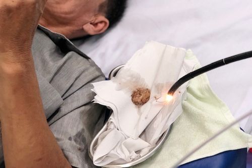 Miếng thịt heo mắc kẹt trong thực quản của người đàn ông 51 tuổi