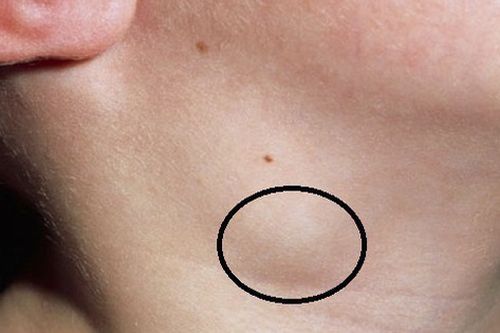Nghĩ bị mụn, không ngờ mắc ung thư hạch