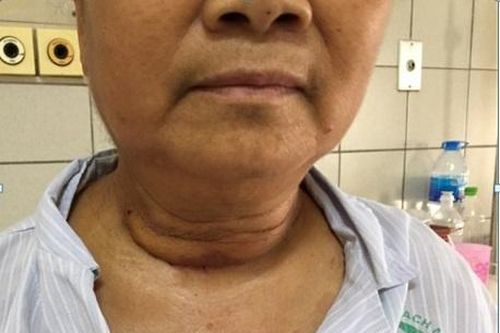 Khối u khổng lồ nằm trong lồng ngực suốt 10 năm