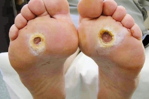 Kẻ giết người thầm lặng này dễ gây biến chứng mù lòa, suy thận, nhồi máu cơ tim