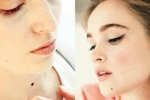 Chỉ cần xóa nốt ruồi này tài lộc đầy nhà, giàu sang ập tới