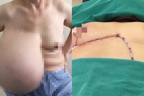 Lấy thành công khối u vú nặng gần 9kg ra khỏi ngực người phụ nữ 64 tuổi