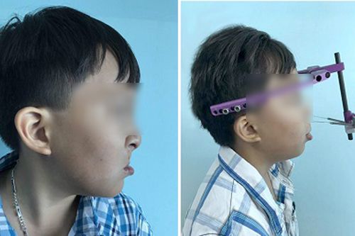 Kéo giãn xương hàm 20cm tái tạo khuôn mặt cho bé trai 10 tuổi