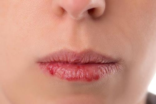 Môi nứt nẻ tiết lộ gì về sức khỏe?