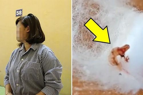 Cô gái Sơn La nặn mụn ở ngực ra nguyên con sán lá gan ngoe nguẩy
