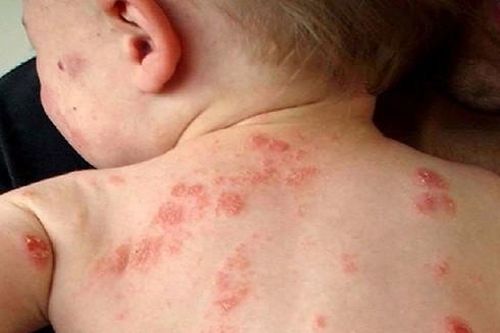 Viêm da cơ địa: Nỗi ám ảnh khôn nguôi