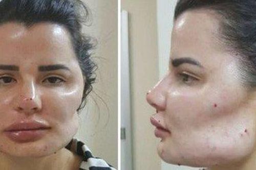 Bác sĩ thẩm mỹ khiến hàng chục bệnh nhân biến dạng mặt, không thể phục hồi