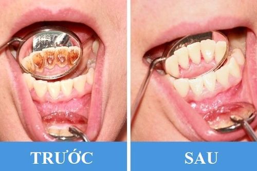 8 thói quen phổ biến gây hại răng miệng