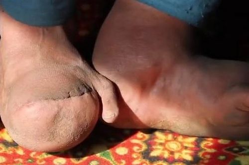Cô gái có gương mặt thiên thần, đôi chân 'ma quỷ' vì bệnh hiếm