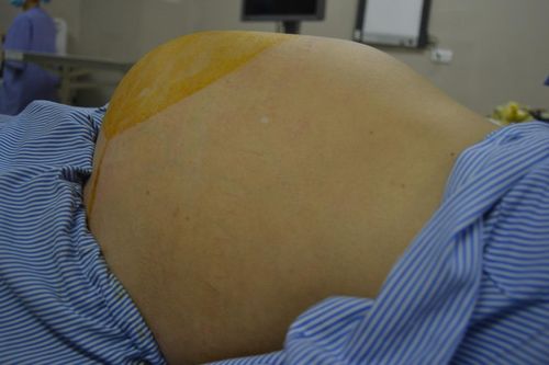 Bụng to như mang thai 8 tháng vì khối u nhầy nặng 6 kg