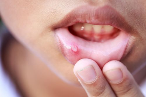 Khổ sở vì nhiệt miệng thi nhau mọc sau Tết