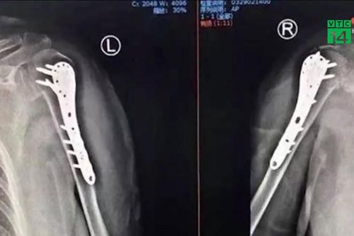 Vợ gãy xương sau cái ôm của chồng