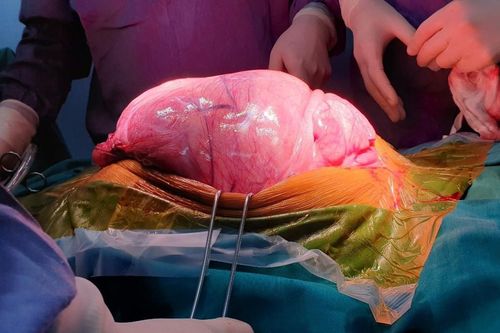 'Choáng' trước khối u 25kg lôi ra từ bụng nam thanh niên