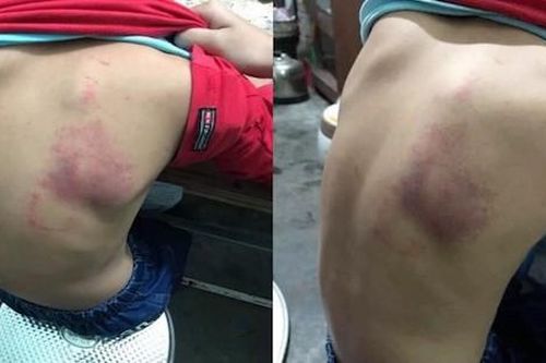 Cô giáo ở Hải Phòng bị tố đánh tím lưng học sinh lớp 2