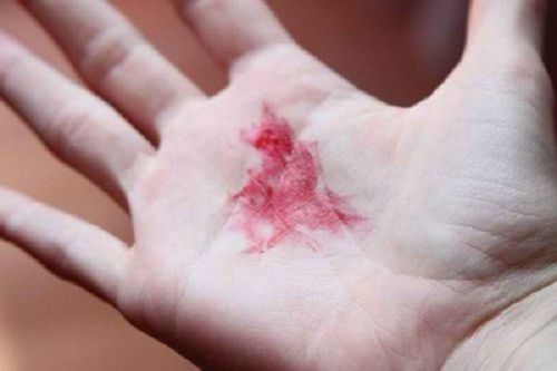 Nguy kịch sau khi nôn và tiểu ra nhiều máu