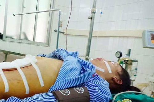 Phẫu thuật khối u buồng trứng nặng gần 8kg cho bệnh nhân 22 tuổi