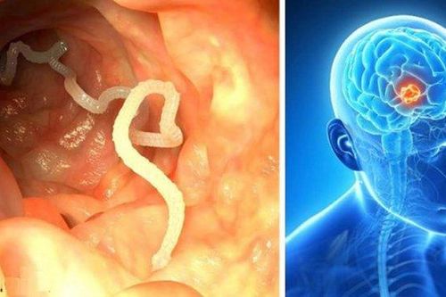 Cận cảnh ổ sán làm tổ trong não người đàn ông hay ăn tiết canh lợn