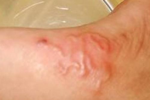 Cách phòng tránh nguy hiểm do bệnh sán lợn
