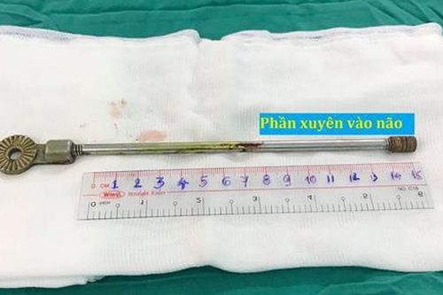 Bé trai bị thanh sắt đâm xuyên mi mắt chui vào trong não