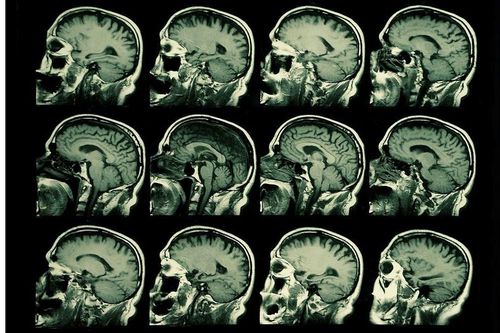 Truyền điện tới... não để phục hồi trí nhớ cho người