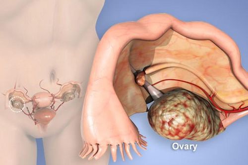 Thận trọng với những căn bệnh buồng trứng dễ gây vô sinh