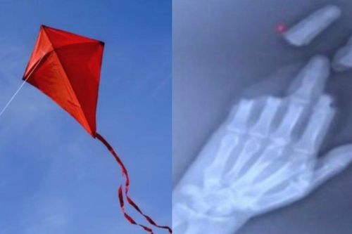 Người đàn ông mất 3 ngón tay vì thả diều đàn ôngđứt taythả diêùđứt 3 ngón tay