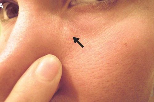 Người đàn ông suýt mù vì giun chỉ dài 15 cm ký sinh trong mắt