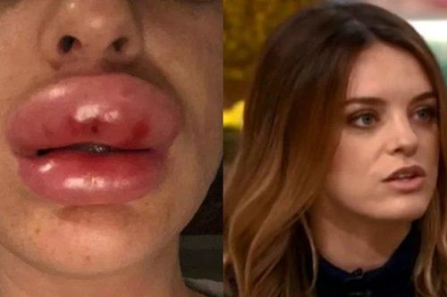 Tiêm botox tại nhà, đôi môi của cô gái trẻ sưng gấp 4 lần bình thường