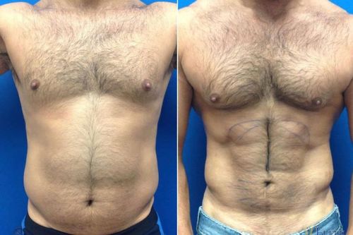 Các chàng 'bụng bia' đang phát cuồng với xu hướng phẫu thuật tạo 6 múi