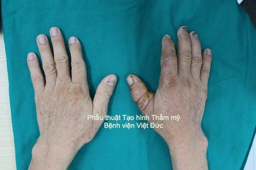 Nối thành công ngón tay cái đứt rời cho người đàn ông 67 tuổi