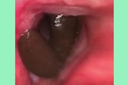 'Sinh vật lạ' ký sinh cả tháng trong khí quản bệnh nhân 36 tuổi