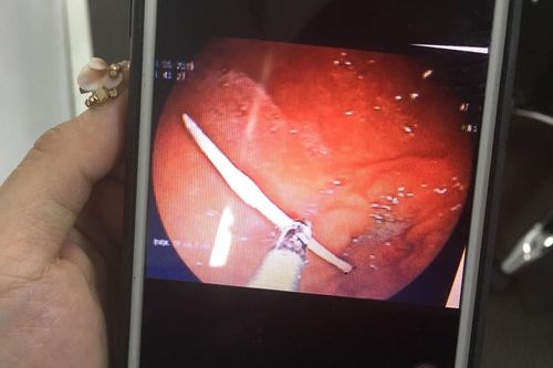 Xương cá mắc kẹt trong hành tá tràng gây đau bụng suốt một tuần