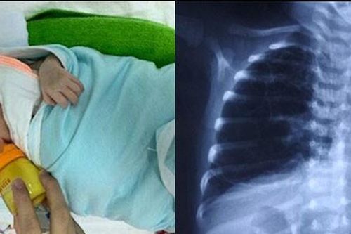 Trẻ khò khè, hay bị viêm phổi: Có thể đã bị dị dạng đường thở