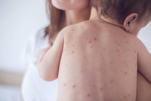 Dịch sởi vẫn chưa có dấu hiệu hạ nhiệt tại Mỹ, số ca mắc tiếp tục tăng