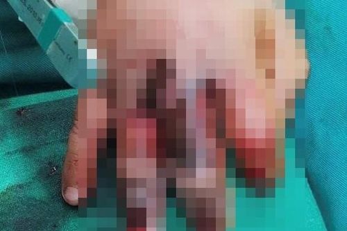Máy ép mía kẹp dập bàn tay bé 4 tuổi